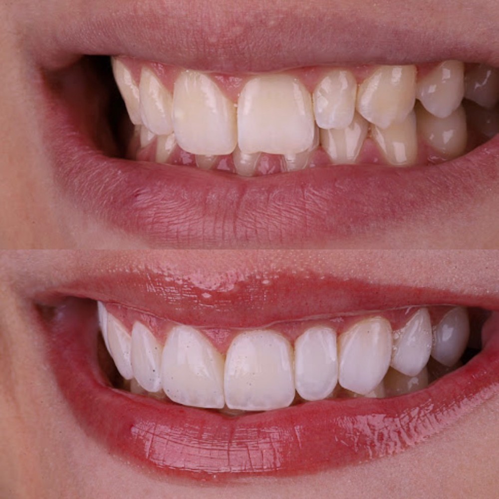 Antes e depois de facetas em resina — Dra. Sthefanie Furlan, dentista em Itapira