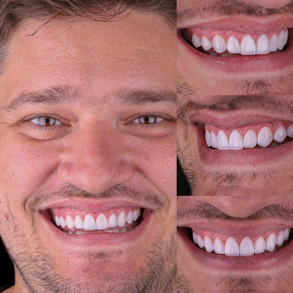 Resultado de facetas dentais realizadas pela Dra. Sthefanie Furlan em Itapira
