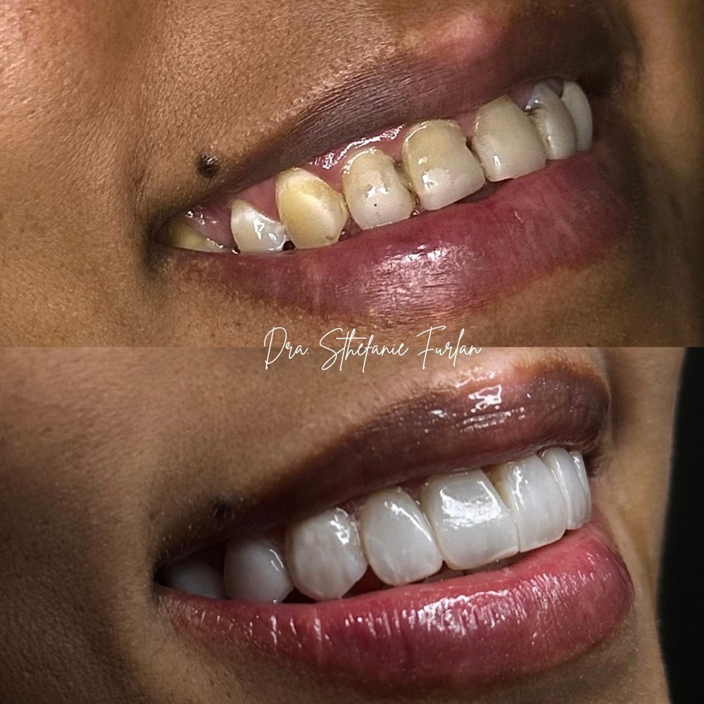Caso antes e depois de reabilitação estética com facetas em resina em Itapira