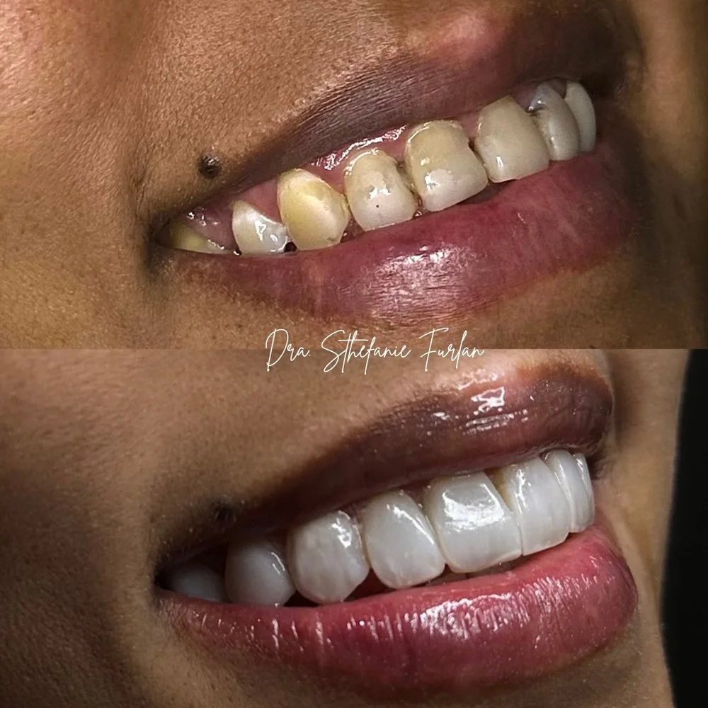 Caso antes e depois de reabilitação estética com facetas em resina em Itapira