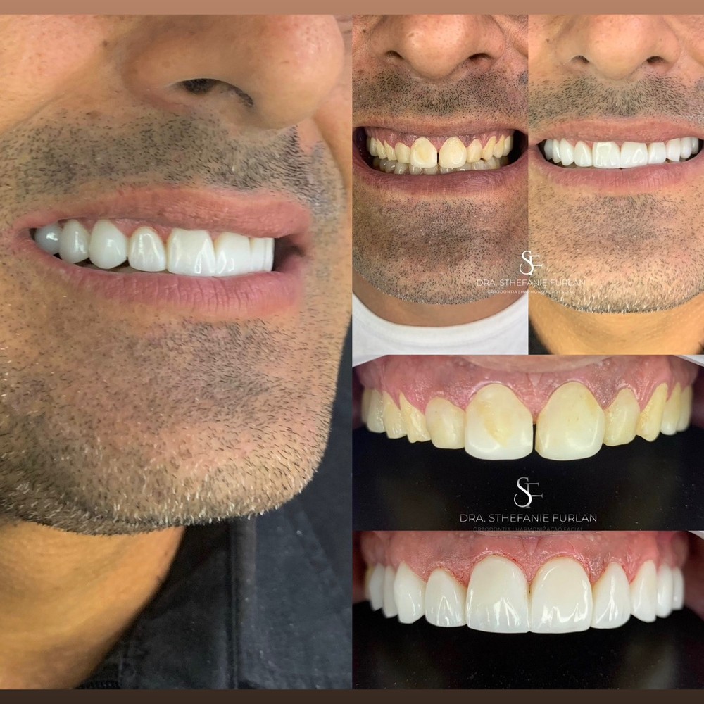 Transformação do sorriso com facetas em resina — Dra. Sthefanie Furlan